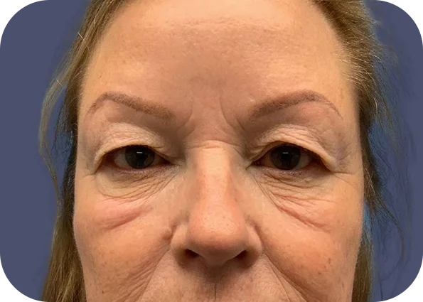 eye5