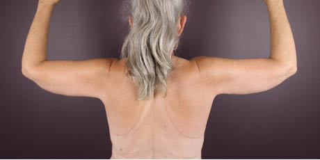 1_0000_armlift (1).jpeg