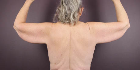 1_0001_armlift (2).jpeg