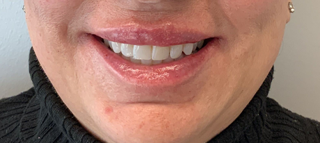 lip filler (1)