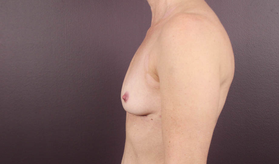 a_0046_jsimplantremove (6).jpeg