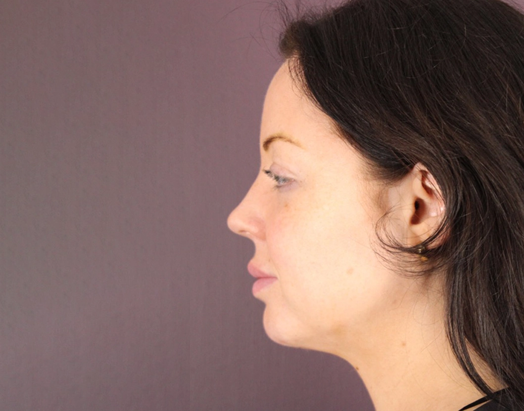 submental (2).jpeg copy